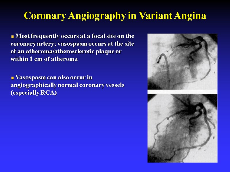 Coronary Angiography in Variant Angina  Most frequently occurs at a focal site on